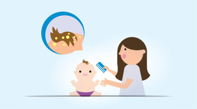 What’s Cradle Cap and how to treat them ?